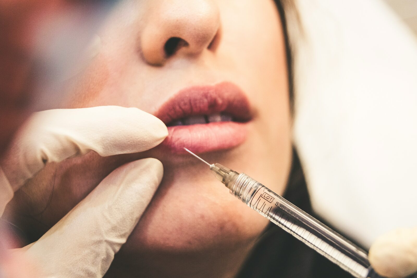 Behandelaar met handschoen zet met een spuit een fillerinjectie in de lippen van een client